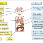 Epstein-Barr Virus EBV Infection Causes Symptoms Treatment Complications