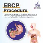 ERCP Procedure Steps Indications Surgery Complications