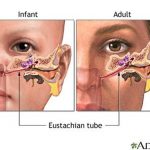 Eustachian Tube Dysfunction Causes Signs Treatment Surgery