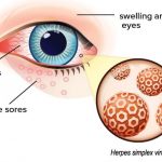 Eye Ocular Herpes Treatment Symptoms Contagious Causes