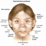 Fetal Alcohol Syndrome FAS Treatment Symptoms Causes