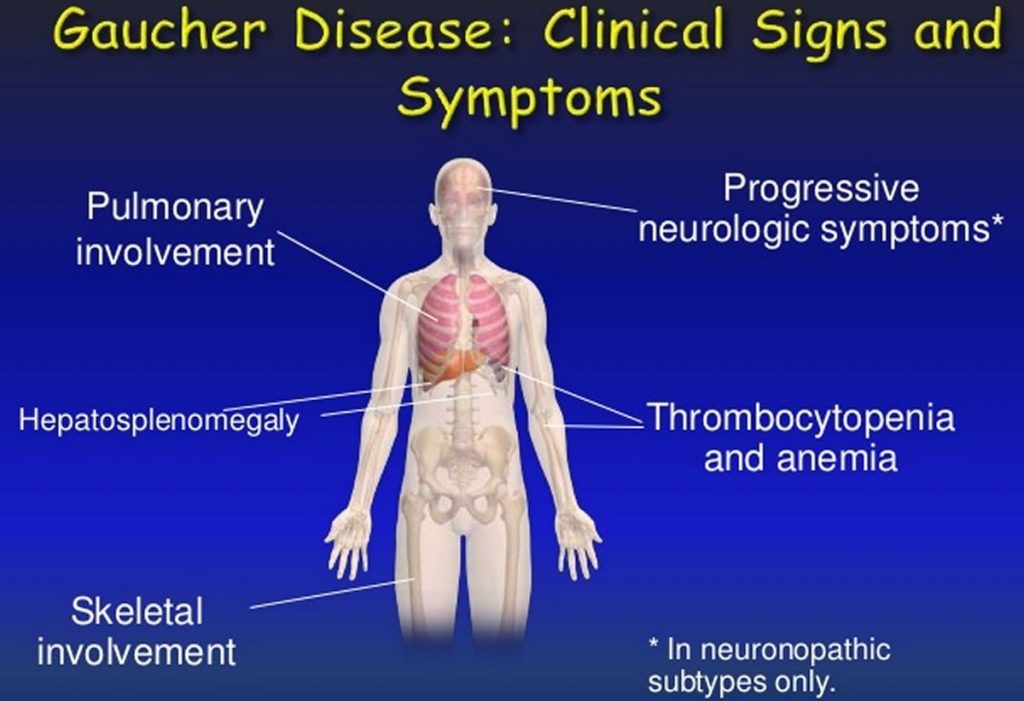 Gaucher Disease 5 Types Symptoms Treatment Causes Inheritance