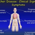 Gaucher Disease 5 Types Symptoms Treatment Causes Inheritance