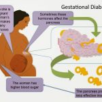 Gestational Diabetes Causes Symptoms Test Diet Treatment