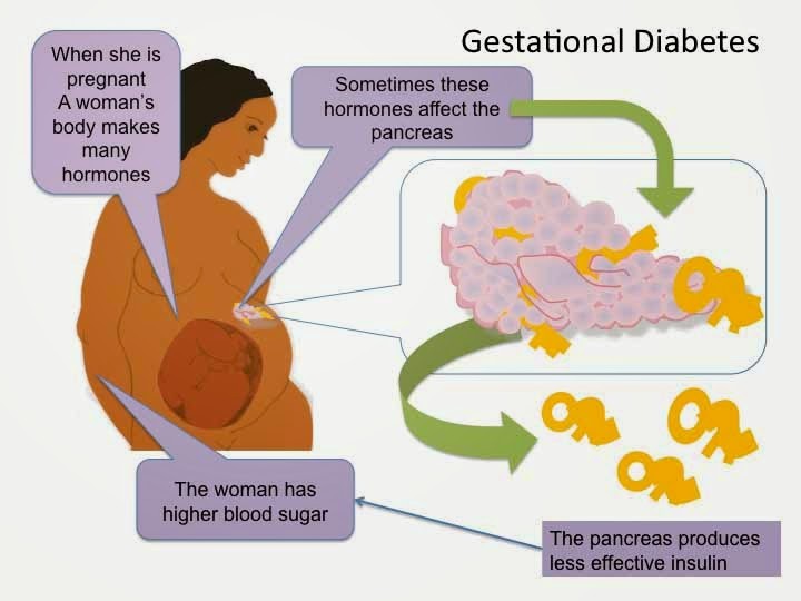 Gestational Diabetes Causes Symptoms Test Diet Treatment