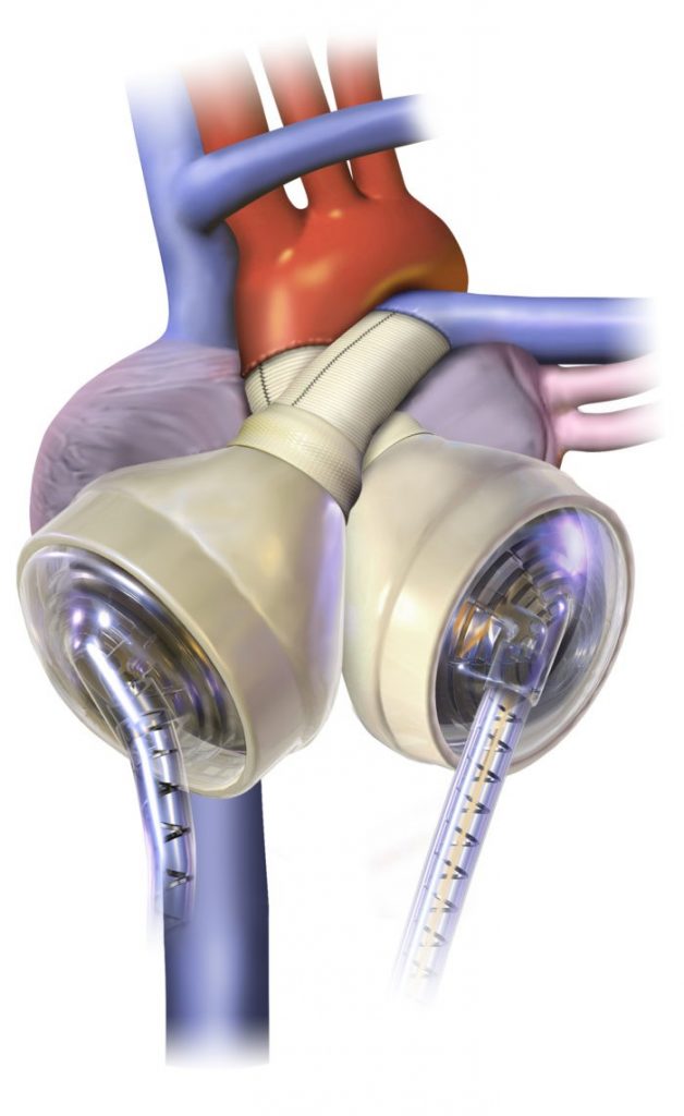 Heart Transplant Surgery Artificial Hearts Costs Rejection