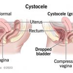 How Can I Stop My Cystocele From Getting Worse 4 Treatments