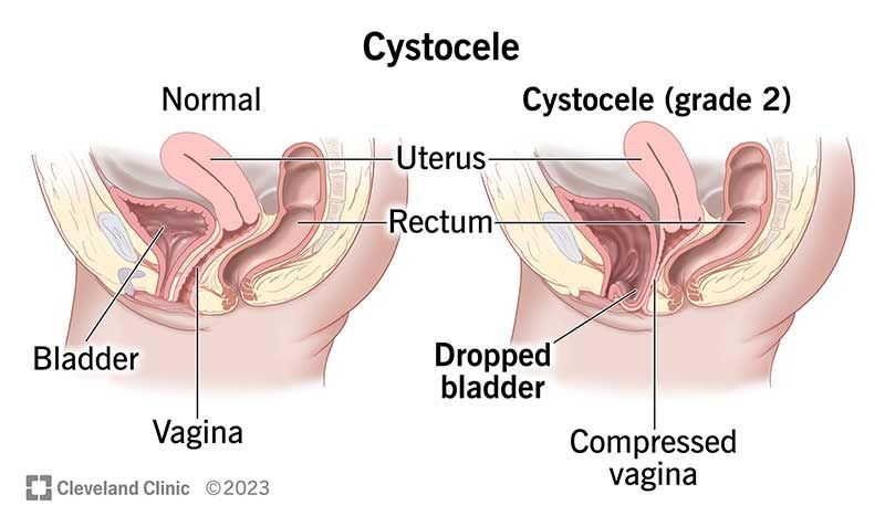 How Can I Stop My Cystocele From Getting Worse 4 Treatments