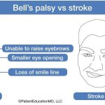 How Can You Tell the Difference Between Bell s Palsy and a Stroke