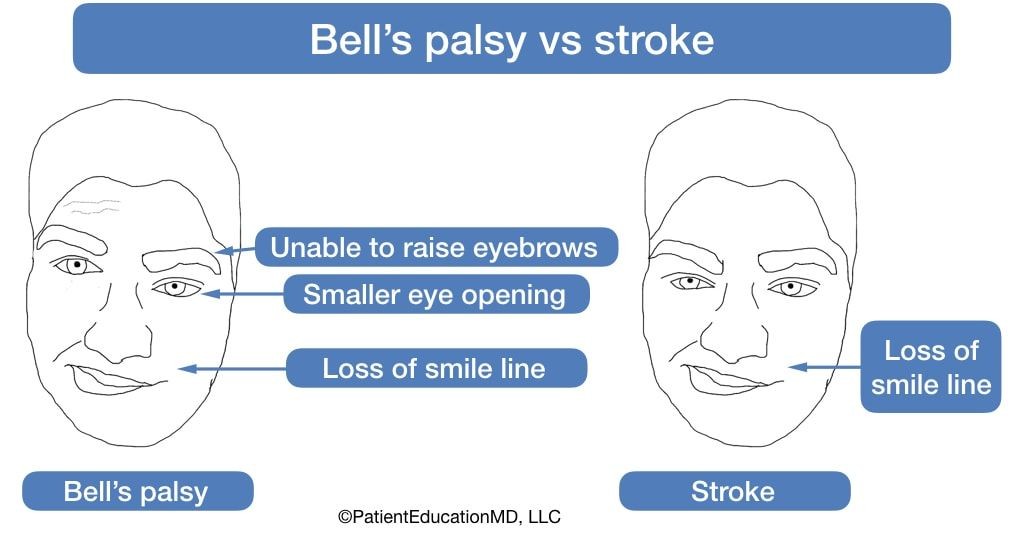 How Can You Tell the Difference Between Bell s Palsy and a Stroke