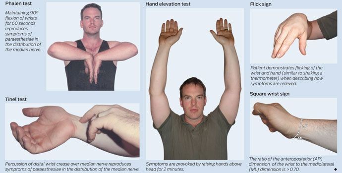 How Do I Know If It s Carpal Tunnel or Arthritis Tests Symptoms