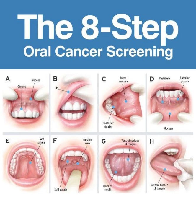 How Do You Detect Oral Cancer 6 Signs Symptoms Diagnosis