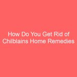 How Do You Get Rid of Chilblains Home Remedies Treatment
