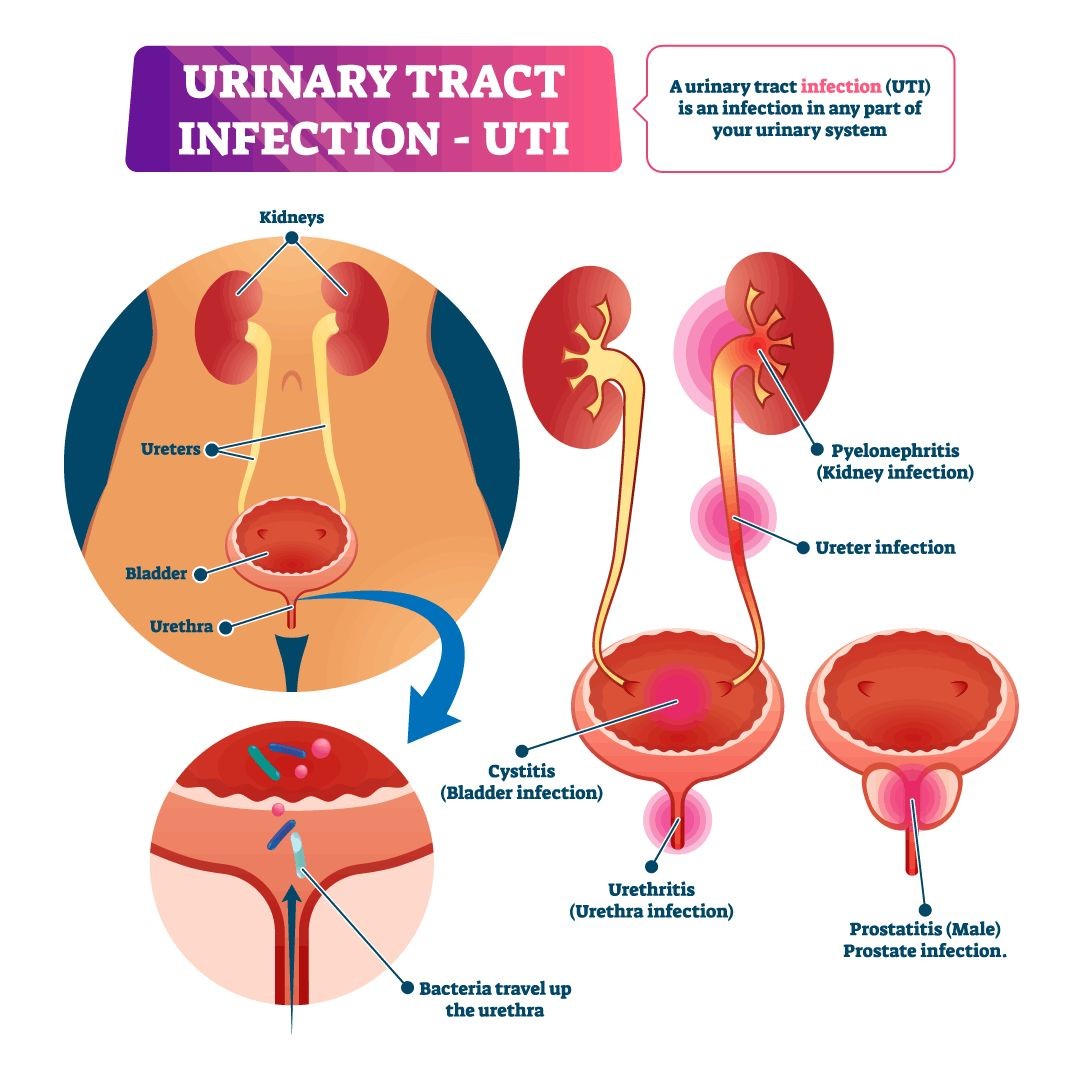 How Do You Know if a UTI Has Spread to Your Kidneys