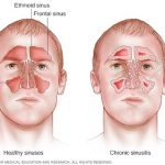 How Do You Know if You Have a Sinus Infection Sinusitis or COVID-19