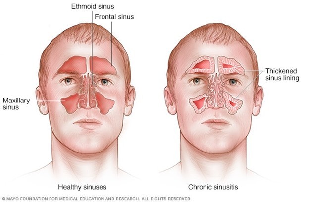 How Do You Know if You Have a Sinus Infection Sinusitis or COVID-19