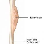 How Long Do You Live With Bone Cancer 7 Types Survival Rate