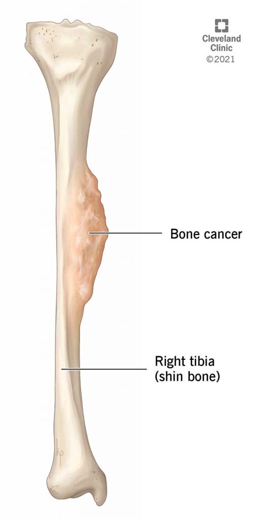How Long Do You Live With Bone Cancer 7 Types Survival Rate