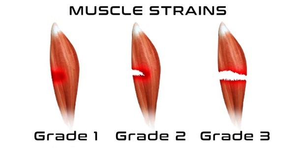 How Long Does It Take for a Muscle Strain to Heal