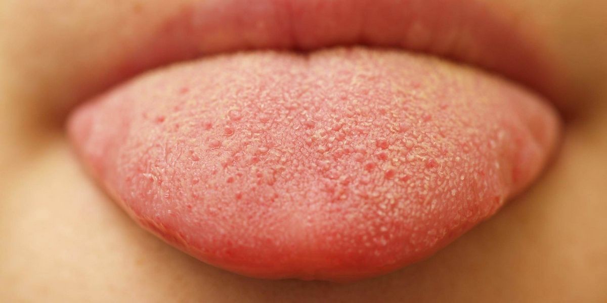 How Long Does Oral Thrush Last Without Treatment Causes Risk Factors