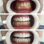 How Much Do Teeth Veneers Cost Per Tooth Types Alternatives