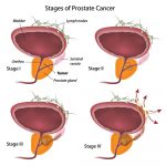 How Quickly Does Prostate Cancer Spread