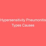 Hypersensitivity Pneumonitis Types Causes Symptoms Treatment