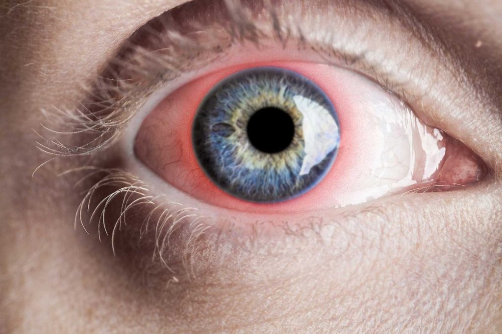 Iritis Causes Symptoms vs Uveitis Treatment Complications