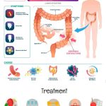 Irritable Bowel Syndrome IBS Quiz Answer Top Questions