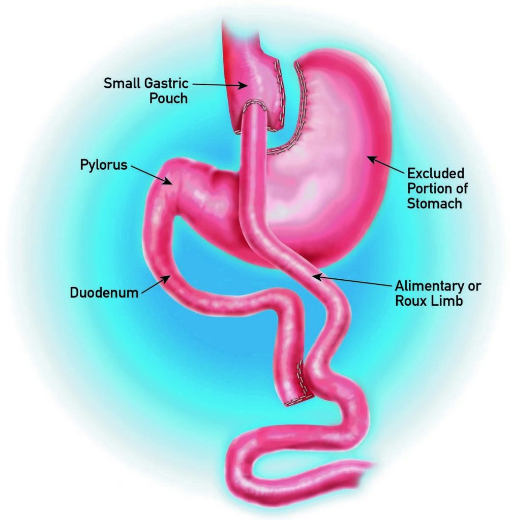 Is Bypass Surgery Safe for a 75-Year-Old Survival Rate