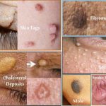 Is It Genital Warts or Skin Tags