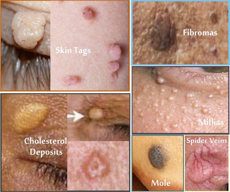 Is It Genital Warts or Skin Tags