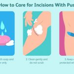 Is Pus a Sign of Infection What Causes It