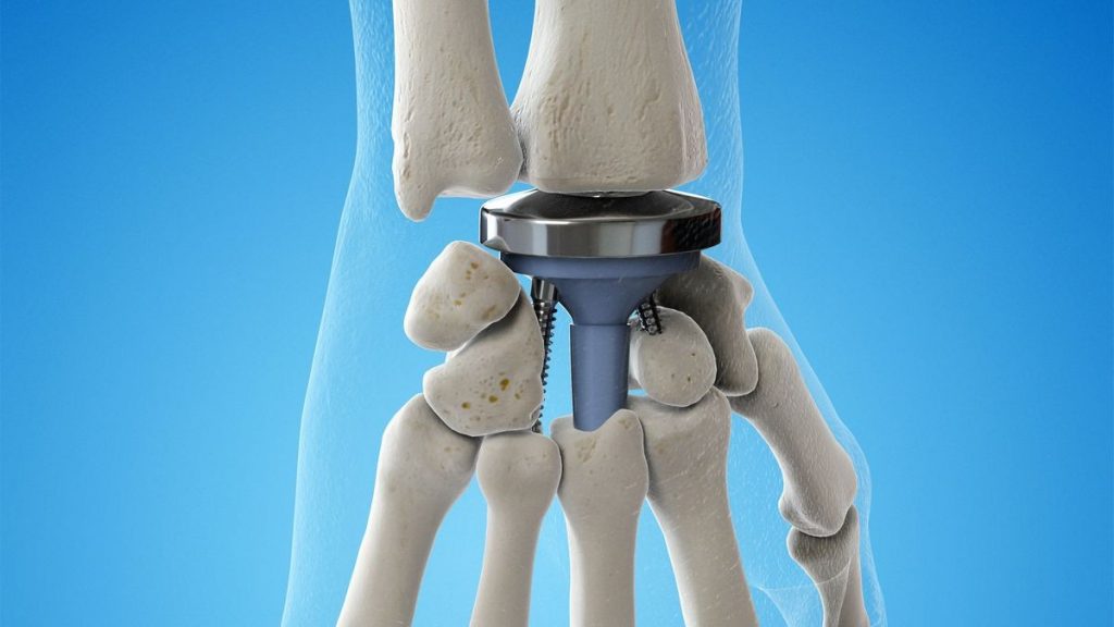 Joint Replacement Surgery of the Hand Procedure and Implants