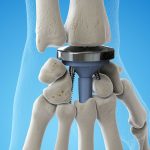 Joint Replacement Surgery of the Hand Procedure and Implants