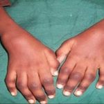 Juvenile Rheumatoid Arthritis JRA