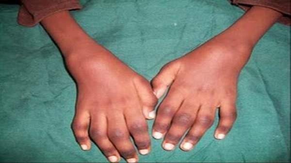 Juvenile Rheumatoid Arthritis JRA