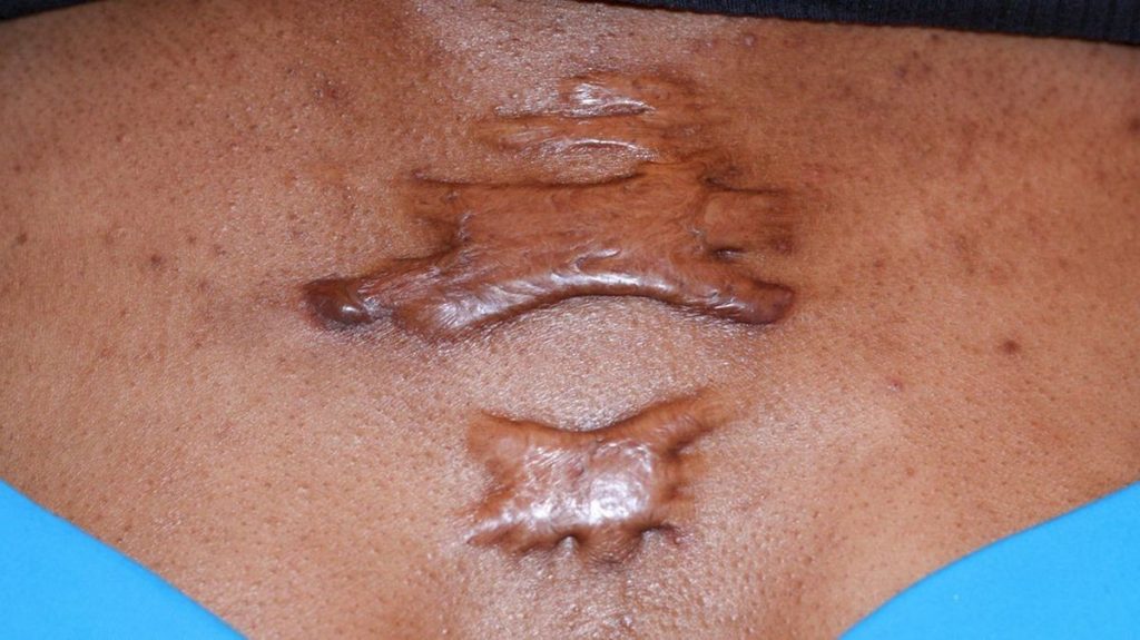 Keloid Scar Pictures Causes Symptoms Cream Removal