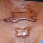 Keloid Scar Pictures Causes Symptoms Cream Removal