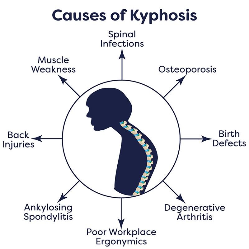 Kyphosis Causes Symptoms Surgery