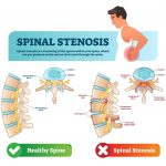Lumbar Spinal Stenosis Causes Symptoms Treatment Surgery
