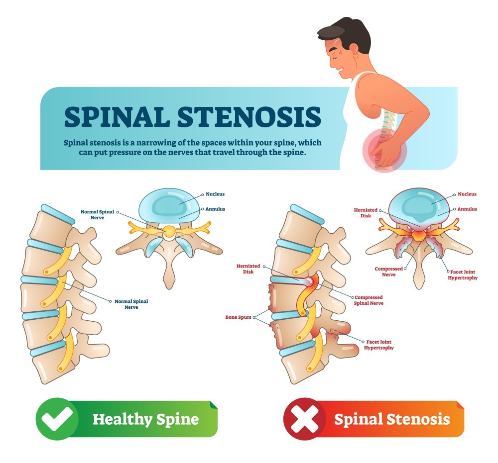Lumbar Spinal Stenosis Causes Symptoms Treatment Surgery
