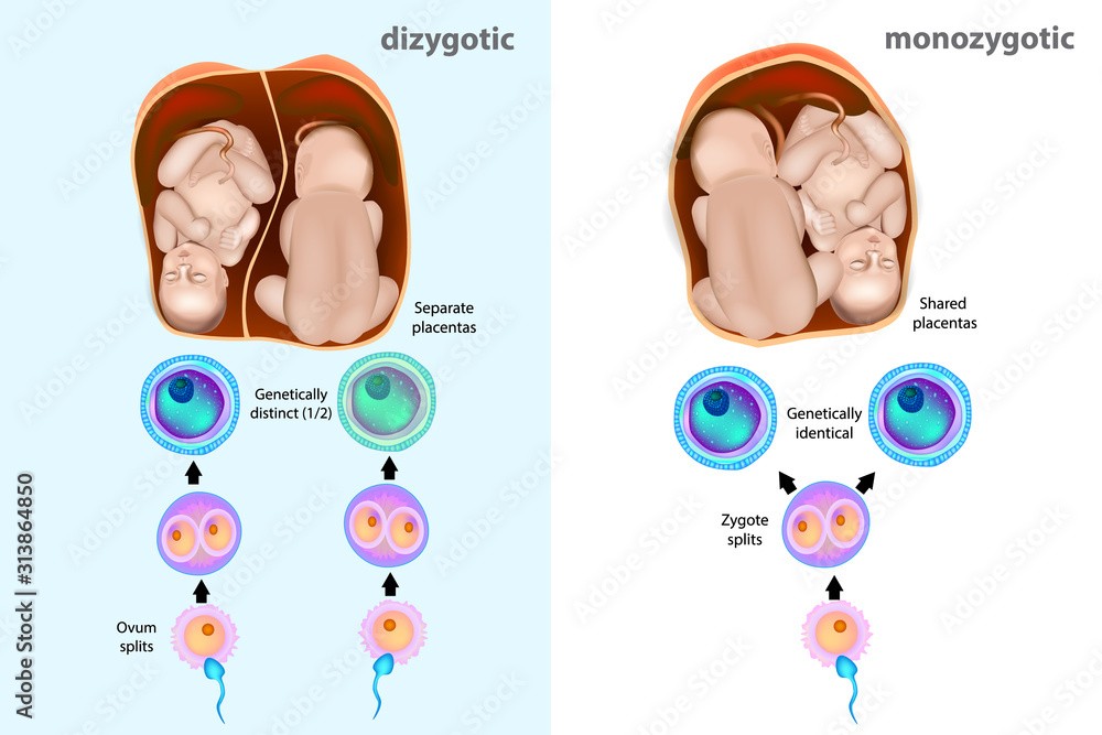Monozygotic Twins vs Dizygotic Twins Differences Meaning