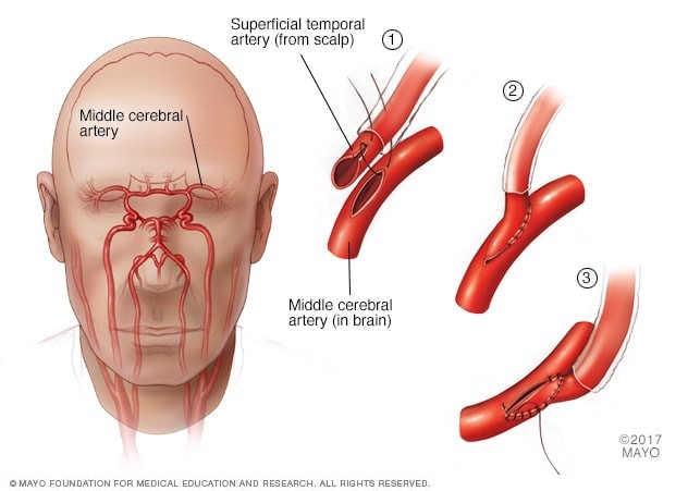 Moyamoya Disease Causes Symptoms Treatment Surgery