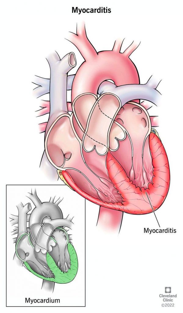 Myocarditis Causes Symptoms Treatment Recovery