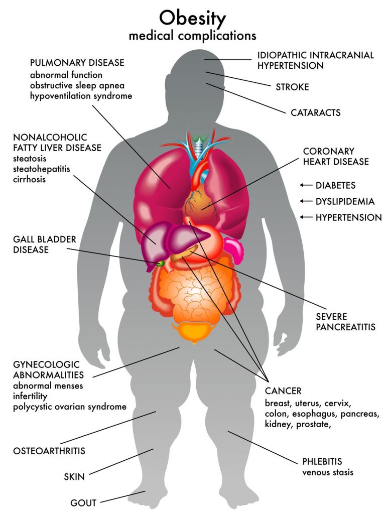 Obesity and Fatty Liver disease on