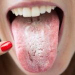 Oral Thrush in Children Treatment Symptoms Signs Causes