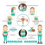 Ovarian Cancer Quiz Symptoms Signs Stages Survival Rate