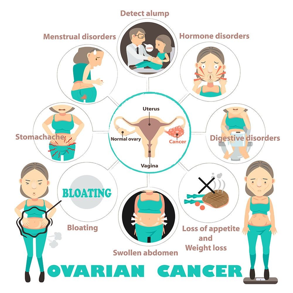 Ovarian Cancer Quiz Symptoms Signs Stages Survival Rate