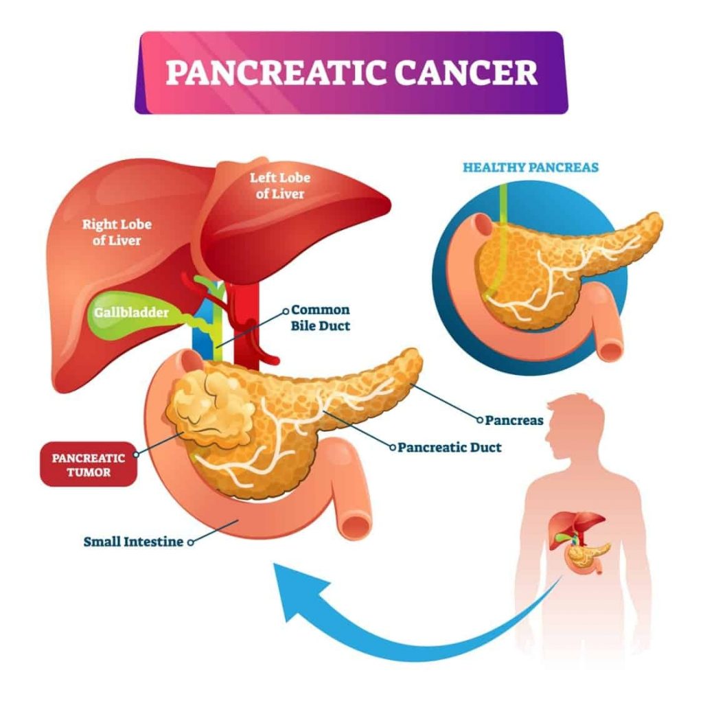Pancreatic Cancer the Silent Disease on